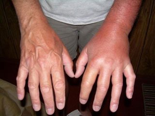 wasp sting allergy